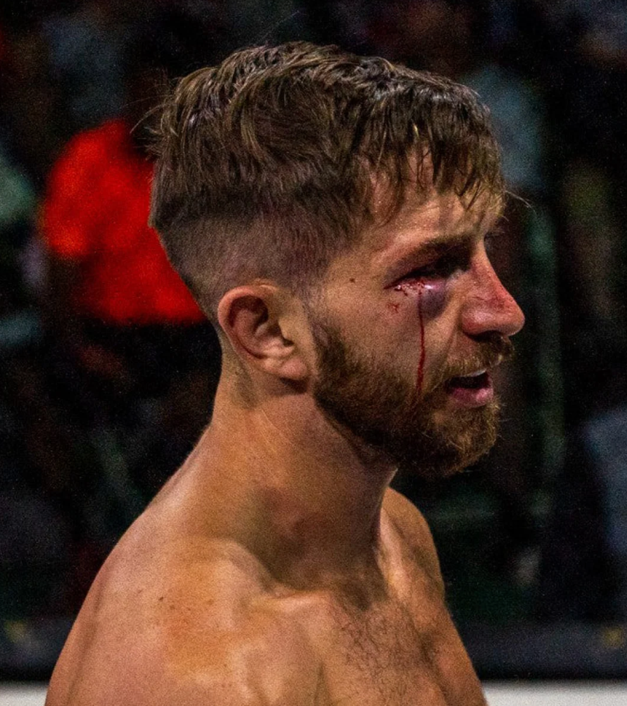 Vance Elrod, founder of Meraki Medicinal, after the MMA fight that shattered his orbital floor